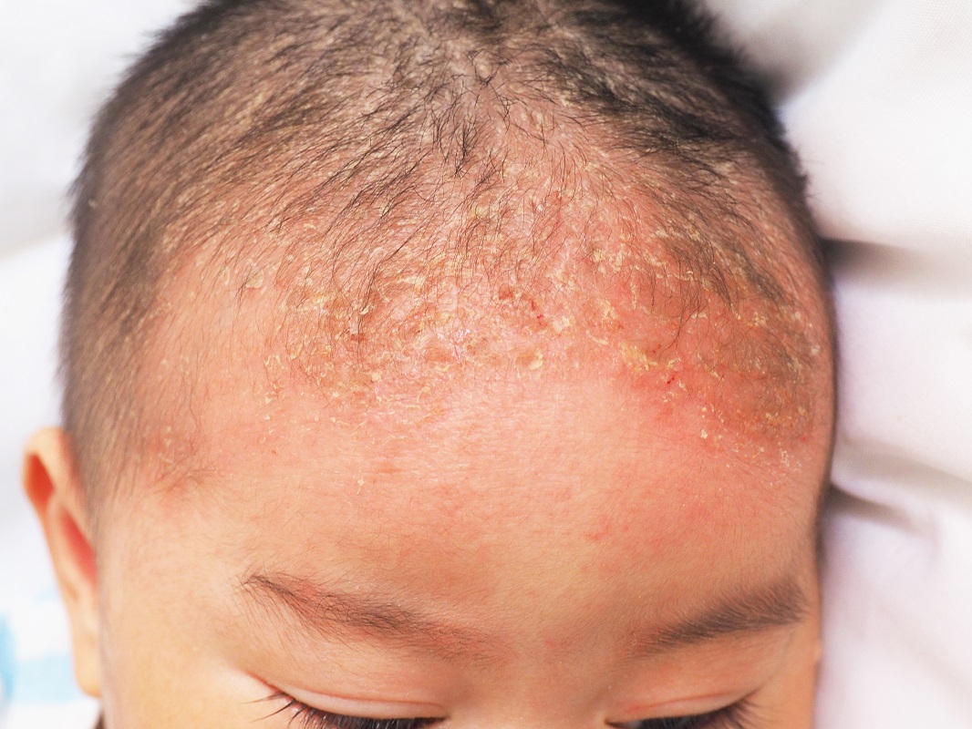 seborrheic dermatitis on the head of a baby